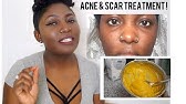 Download Diy Face Mask To Get Rid Of Acne Overnight Results Youtube Yellowimages Mockups