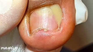 UNHAS COM INFECÇÃO: COMO TRATAR E MANTER A SAÚDE DAS UNHAS  podologomaurelio