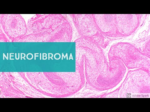 Neurofibroma, Neurofibromatosis tipo 1 y Tumor Maligno de la Vaina Nerviosa Periférica de Bajo Grado