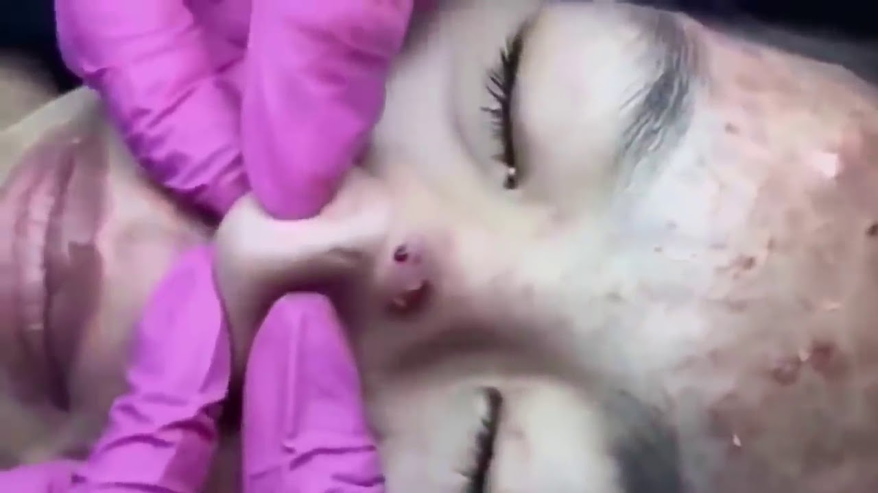 чистка лица Большие прыщи, ужасные прыщи, , отвратительные прыщи, взрывные, взрывных прыщи