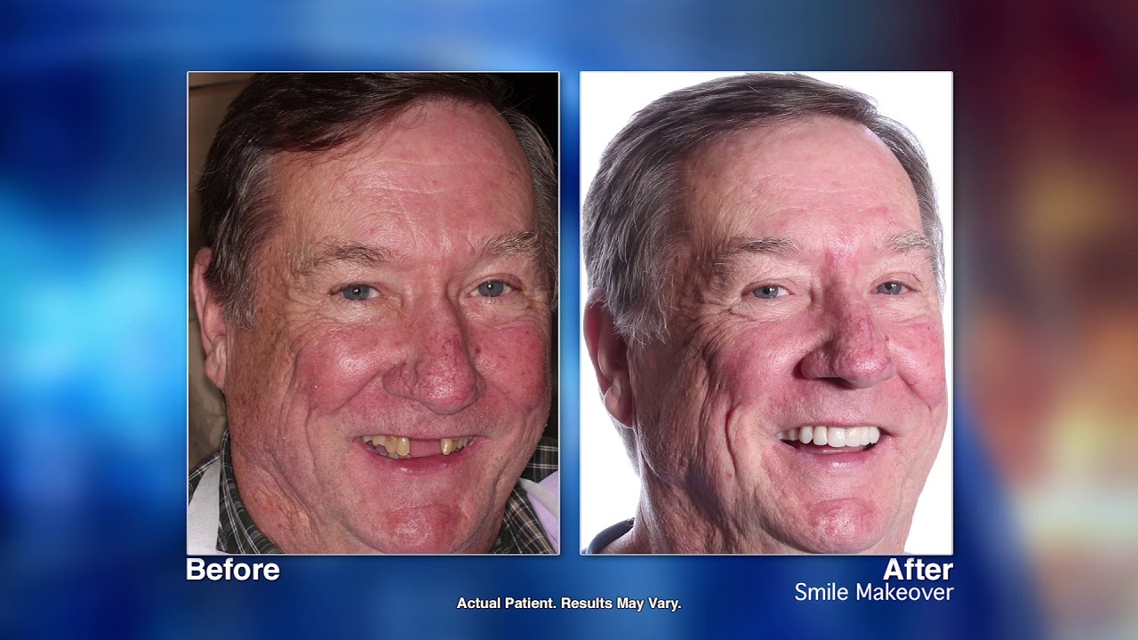 Full Mouth Reconstructions with St. Petersburg, FL dentist Dr. Roberto Macedo