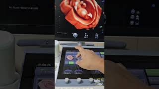 3D Pregnancy Tutorial || Ultrasound