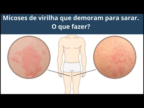 Vídeo: 3 maneiras simples de tratar o intertrigo