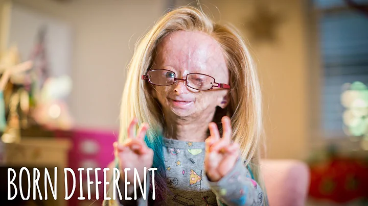Adalia Rose: The Girl Who Ages Too Fast | BORN DIFFERENT - DayDayNews