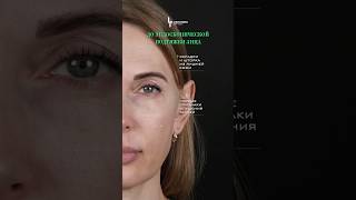 Пластика лица без видимых разрезов! 😎 Пластический хирург ЛИСИН ПАВЕЛ ЭДУАРДОВИЧ #допосле