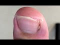 Ingrown nails at the base of the toenails, causing the patient to walk painfully【Xue Yidao】