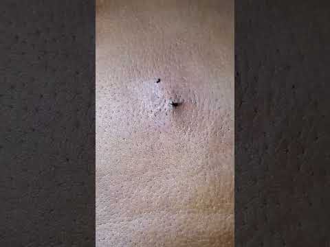 إزالة الرؤوس السوداء من البشرة إزالة أضخم الرؤوس السوداء من البشرة تنظيف البشرة Keishaj9709