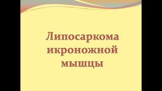 Липосаркома икроножной мышцы