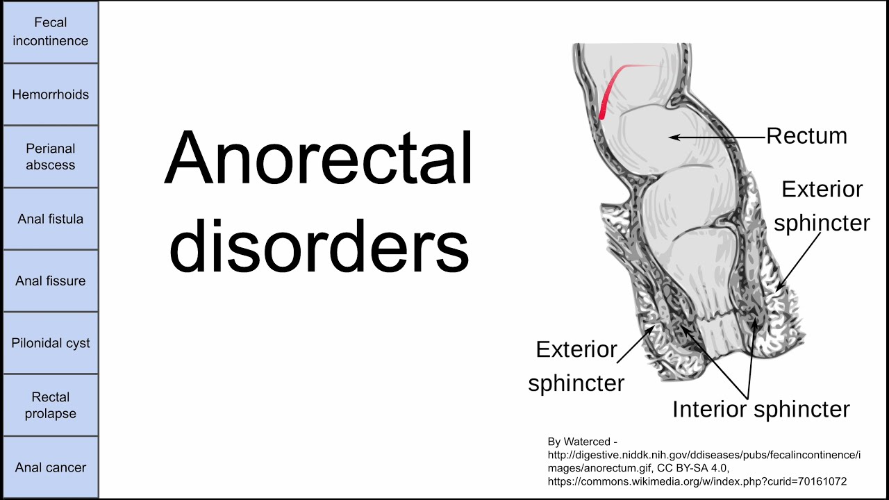 Anorectal disorders
