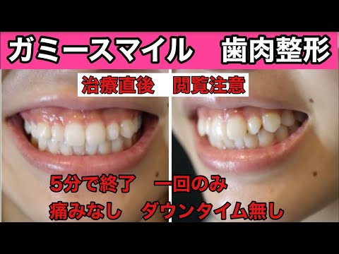笑った時の歯茎の見えすぎに長年悩まれていたかわいらしい女性