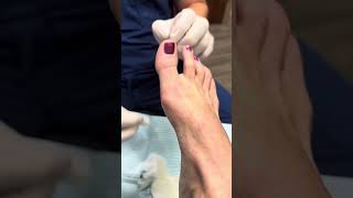 Aspiration of a cyst in the foot by Timonium Foot and Ankle Center 1,911 views 6 months ago 2 minutes, 30 seconds