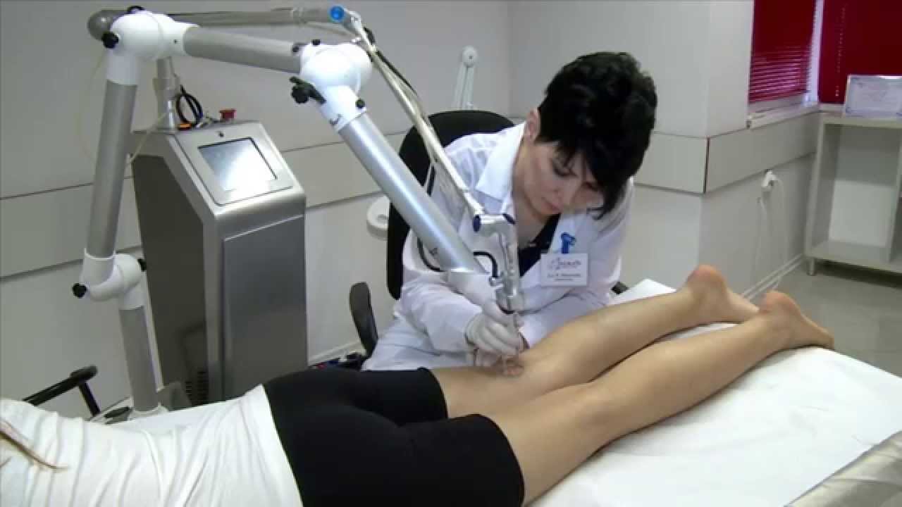 Удаление стрий и растяжек с помощью фракционного CO₂ лазера