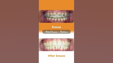 Hành trình LỘT XÁC nhờ niềng răng của Vũ Thị Nga  #braces #updental