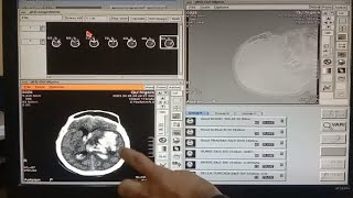 stroke: Hypertensive haemorrhage radiology video tutorial ( MRI CT ) ct scan head |brainhaemorrhage