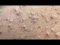 The Most Satisfying Blackheads