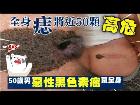 全身痣逾50顆高危 50歲男惡性黑色素瘤竄全身 | 台灣蘋果日報