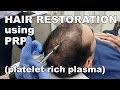 Scalp Hair Restoration using Platelet Rich Plasma - Lori Ward, CRNP | West End Plastic Surgery