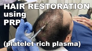 Scalp Hair Restoration using Platelet Rich Plasma | West End Plastic Surgery