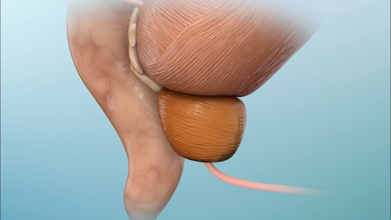 Comprender el cáncer de próstata