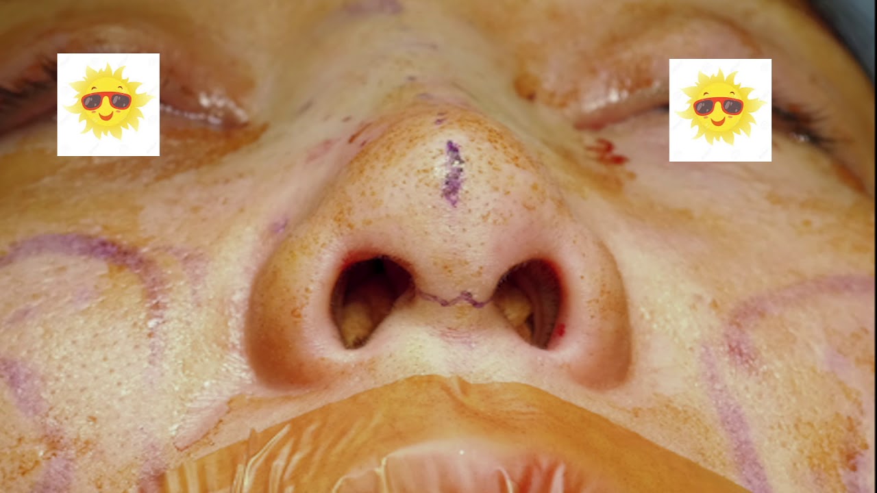 Revision Rhinoplasty using Rib(costal) Cartilage in Korea YouTube