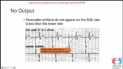 Pacemaker Troubleshooting Dr Amit Malviya