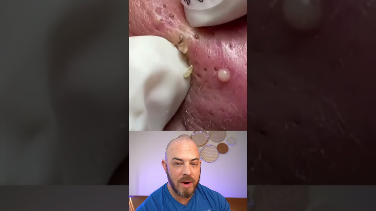 Derm Reacts To Super Satisfying Pimple Pops Dermreacts Doctorreacts Pimplepopper