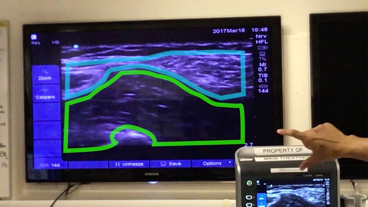 Fascia Iliaca Block Tutorial