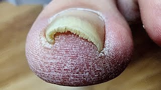 Curvy toenail. Cleaning and cutting.