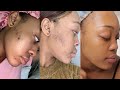 The Skin Care Routine that cleared my acne & hyperpigmentation | OG Parley