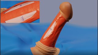 Penile Plication Vs Corporoplasty
