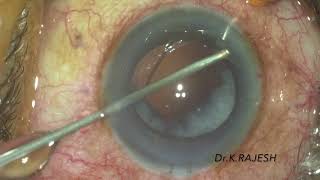 Ant Vit Sulcus Iol Fixation - Video 114
