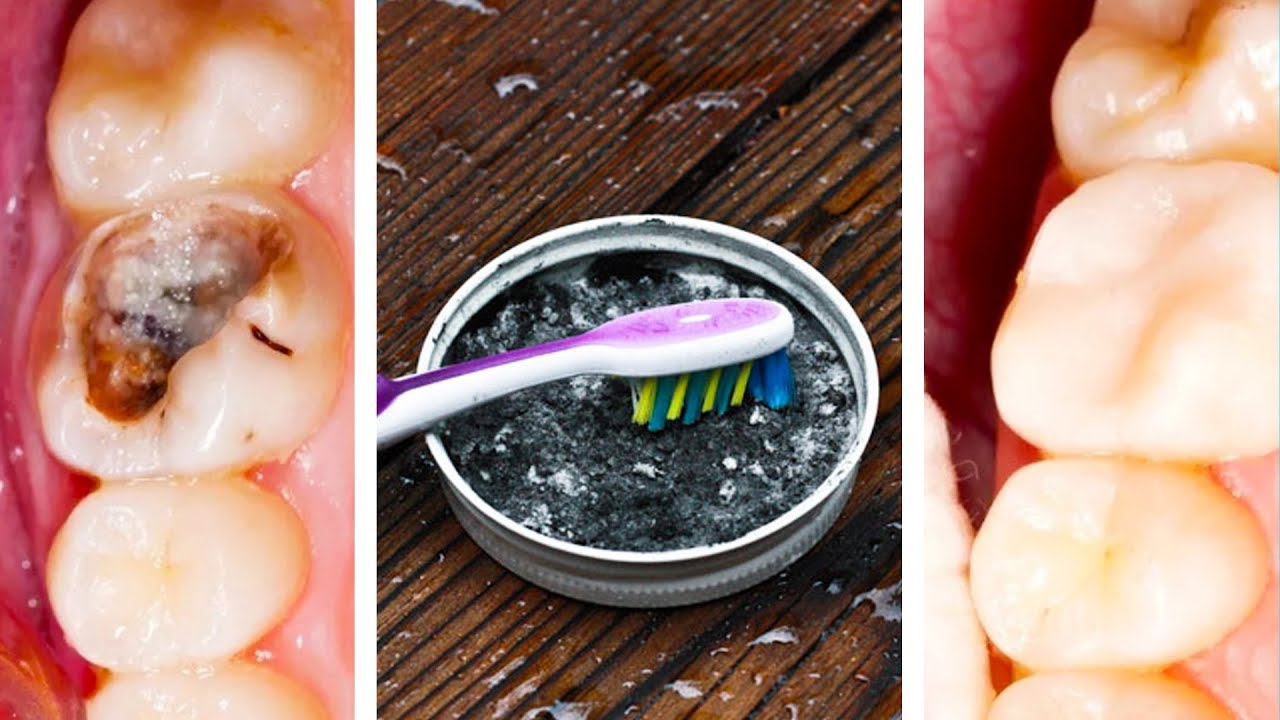 What Are Ways To Prevent Tooth Decay What Are Ways To Prevent Tooth Decay