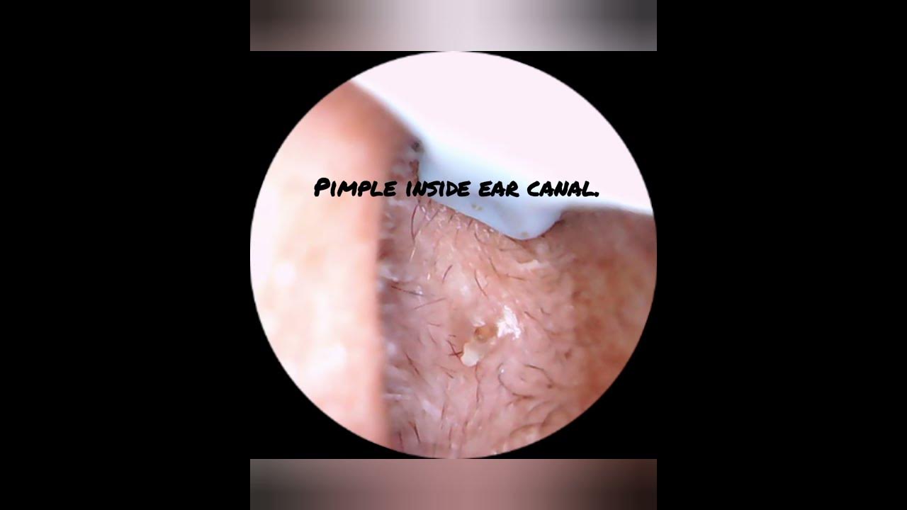 Pimple inside ear canal youtube
