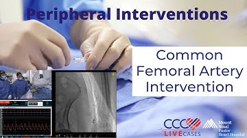 Common Femoral Artery Intervention