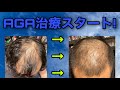 AGA治療スタート！治療プランや現状を説明します