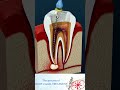 Root canal treatment  tooth abscess