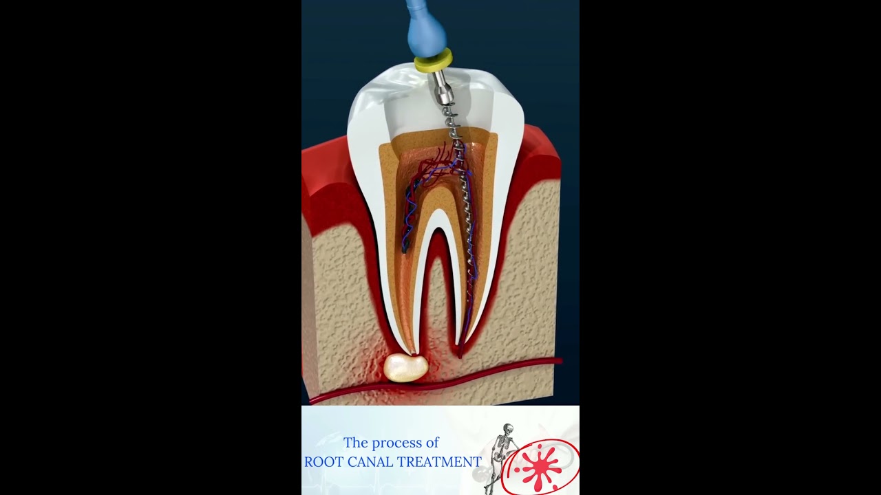 Root Canal Treatment Tooth Abscess