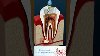 Root Canal Treatment & Tooth Abscess screenshot 4