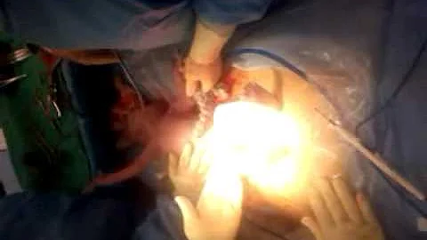 My daughter aariana summer couey being born