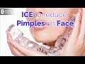 Does ice help in reducing pimples? - Dr. Urmila Nischal | Doctors' Circle