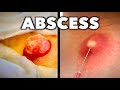 ABSCESS DRAINING & ABSCESS NUMBING (Compilation) | Dr. Paul