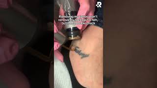 Removing an ex tattoo = freedom👏 #removery