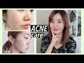 How I Got Rid of Acne Scars & Hyperpigmentation with Korean Skincare