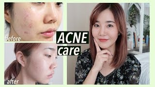 How I Got Rid of Acne Scars & Hyperpigmentation with Korean Skincare