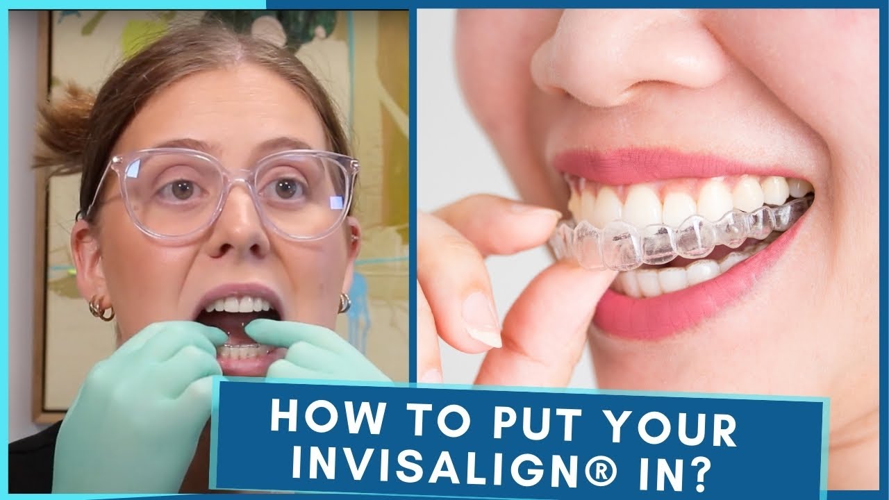 How To Put Your Invisalign® In | Step by Step Guide