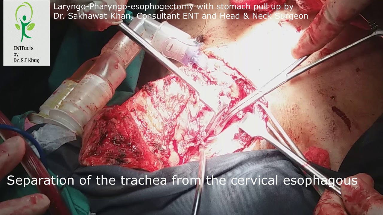 Laryngopharyngoesophagectomy with stomach pull up