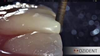 OziDent Video: Amazing Artistic Dental Video to make Veneers