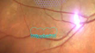 Navilas® - Navigated subthreshold retinal laser treatment with microsecond pulsing