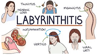 Understanding Labyrinthitis