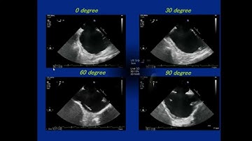 3D-TEE imaging for ASD closure